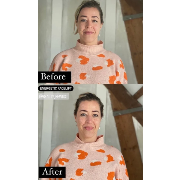 cosmic botox behandeling before and after 3